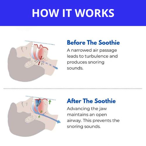The Snorely Anti-Snoring Mouthpiece Universal Size